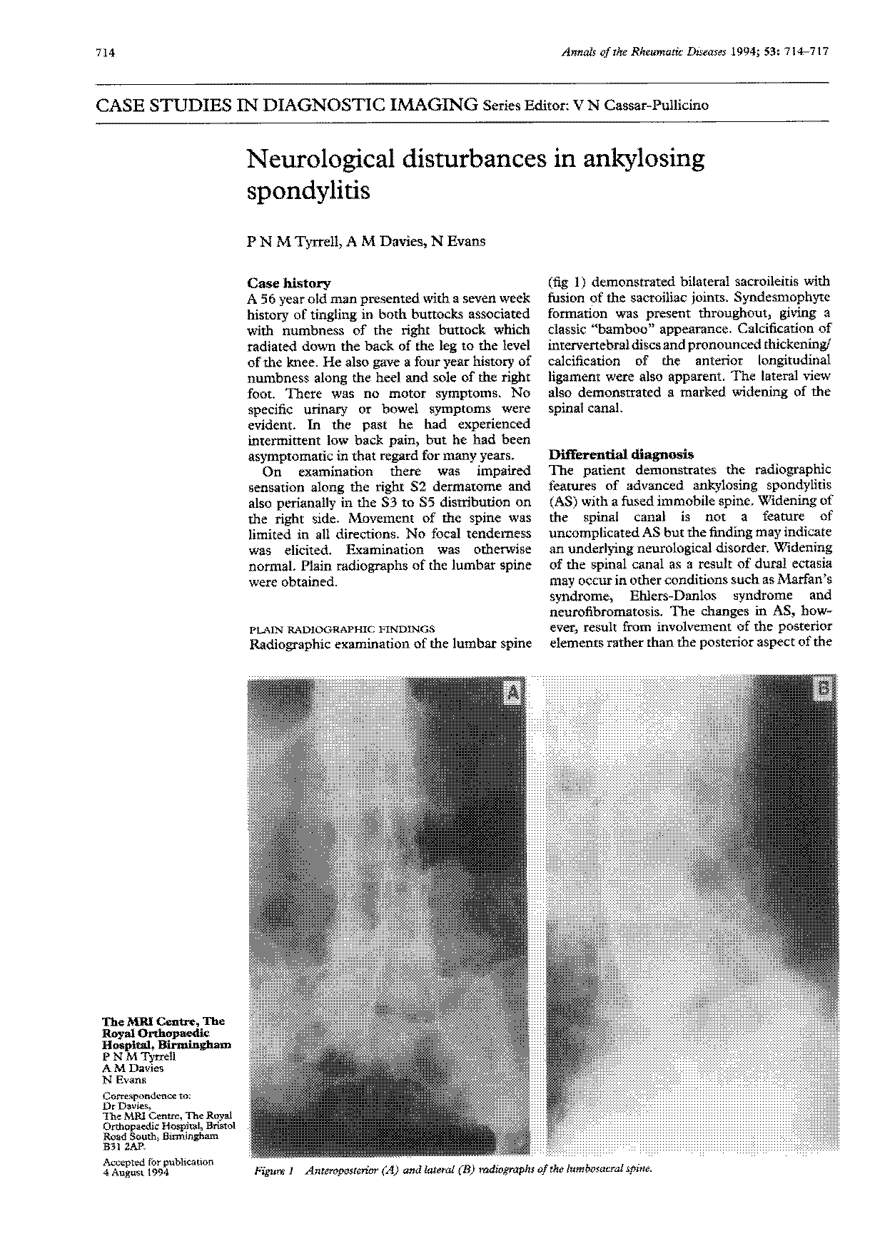 ankylosing spondylitis a case report and review of the literature